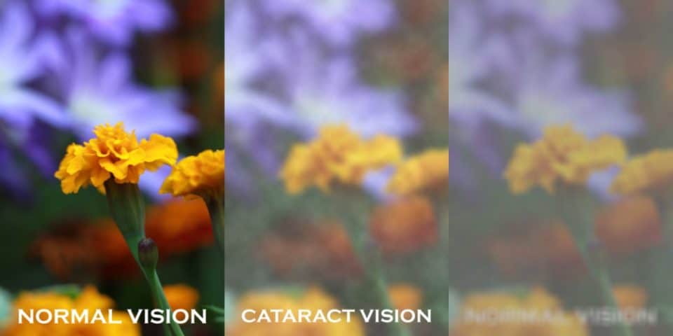 Cataracts: What to expect & how to slow it down