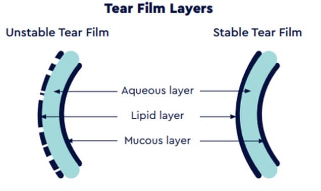 Picture of IPL dry eye treatment showing tear film layers