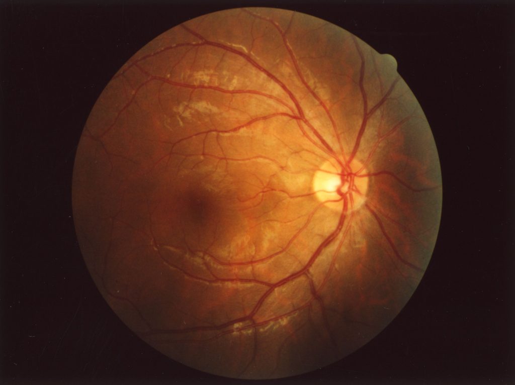 Normal retina
