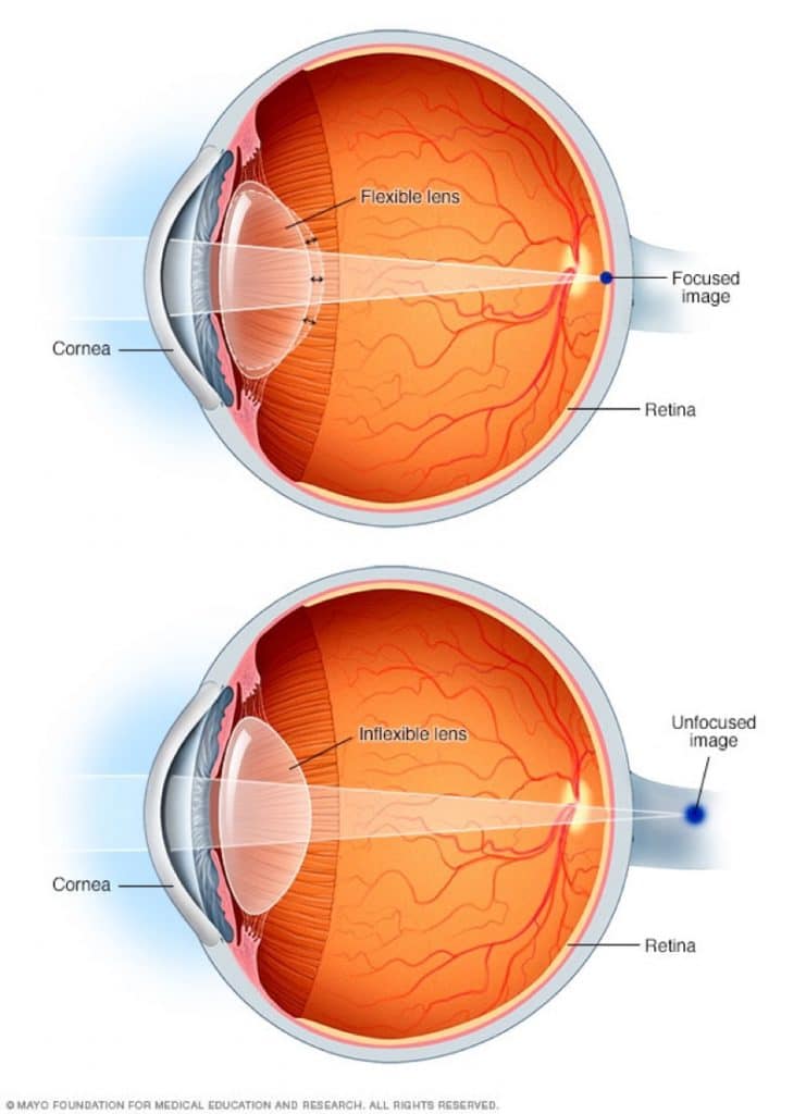 Presbyopia