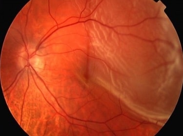 Retinal-Detachment-1