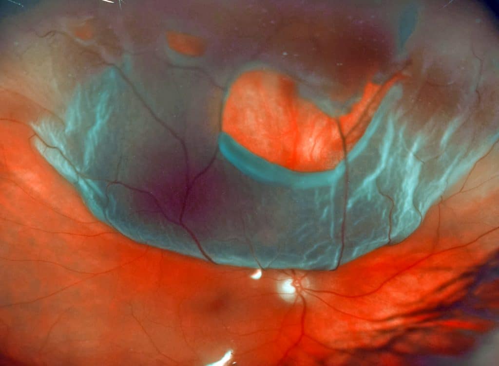 Retinal detachment