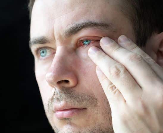man suffering from eye allergy with red swollen eyes