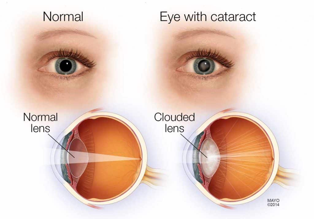 Cataracts Grace & Vision Optometrist Brisbane