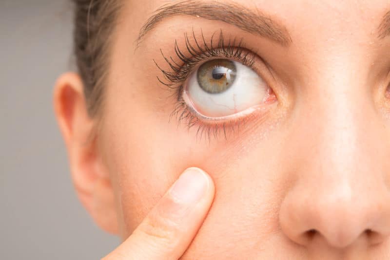 dry-eyes-800x534 Dry Eyes Meibomian
