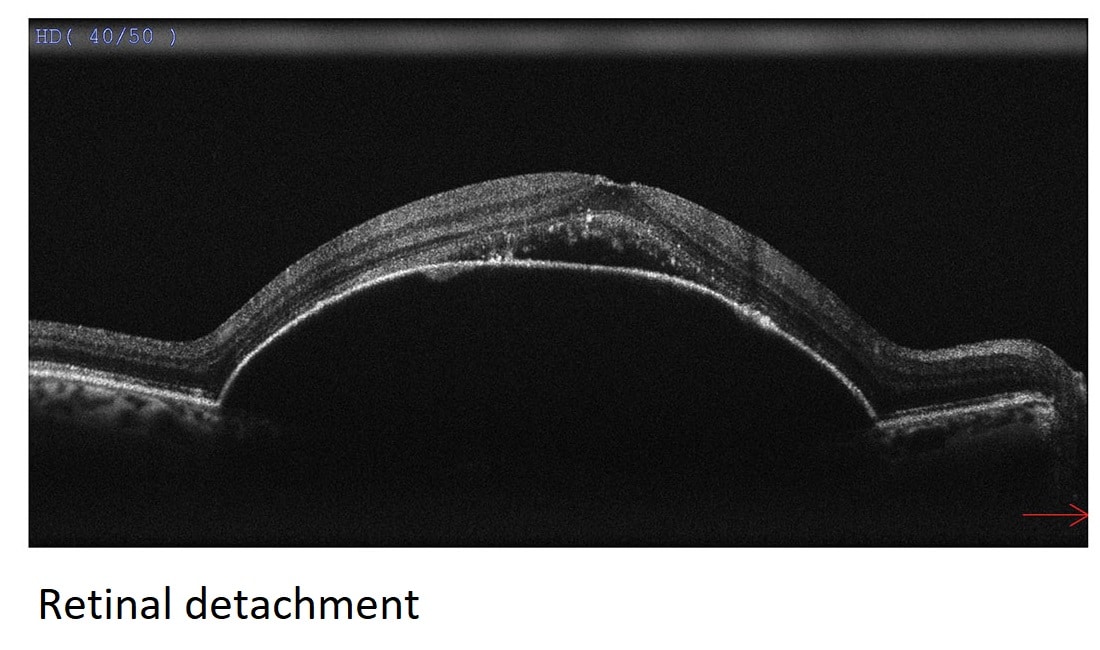 retinal detachment hi res - Copy
