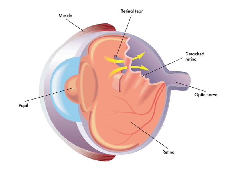 retinal tear